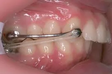 Carriere protruded teeth