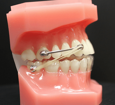 Carriere protruded teeth