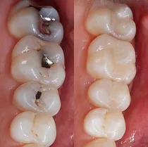 Cavity Fillings