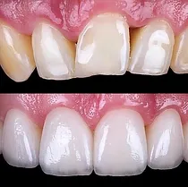 Veneers