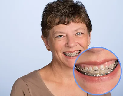 Woman with Braces