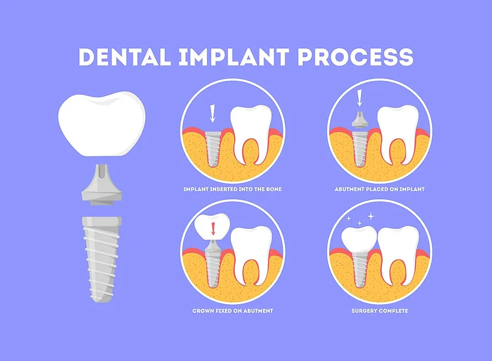dental implants process