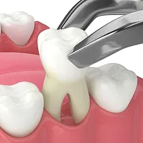Tooth extraction