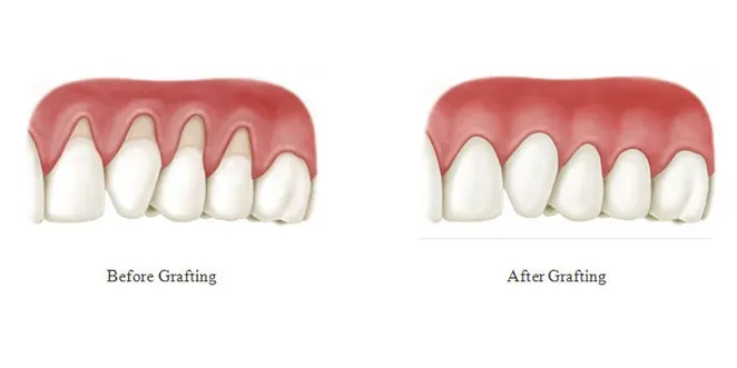 gum graft