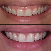 gummy smile