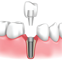 Implant