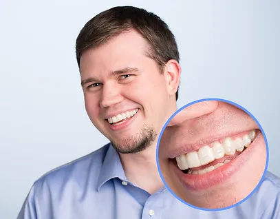 invisalign man smile