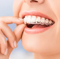 invisalign