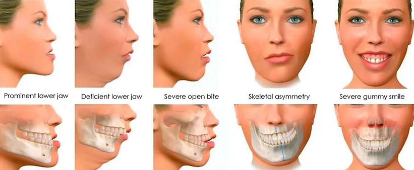 orthognathic surgery explanation image