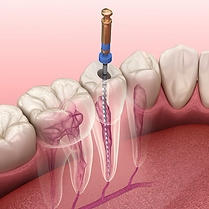 root canal