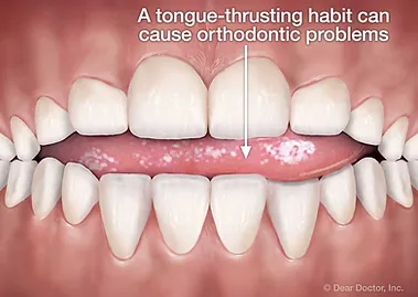 habitbreaker explained