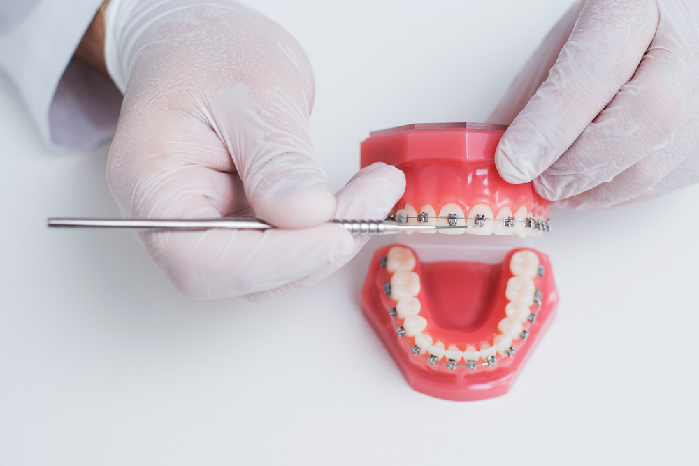 orthodontist shows how the system of braces on teeth is arranged