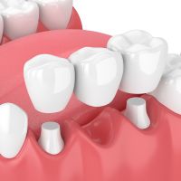 traditional-dental-bridge