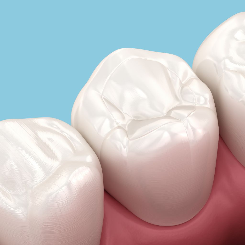 Composite Resin Fillings​