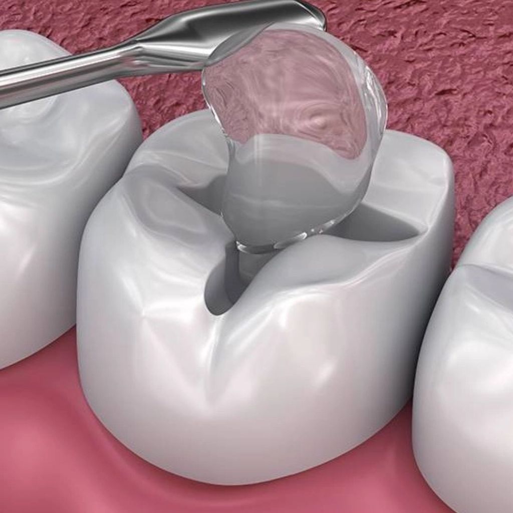 Glass Filling Tooth Dental Fillings in Manhattan, NYC | SmileWorks Dentistry