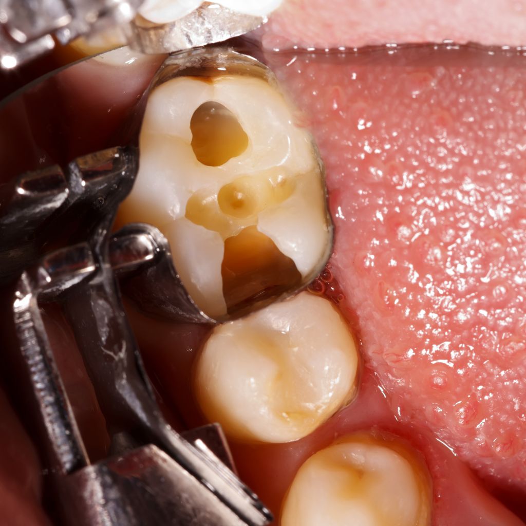 removing dent cavity