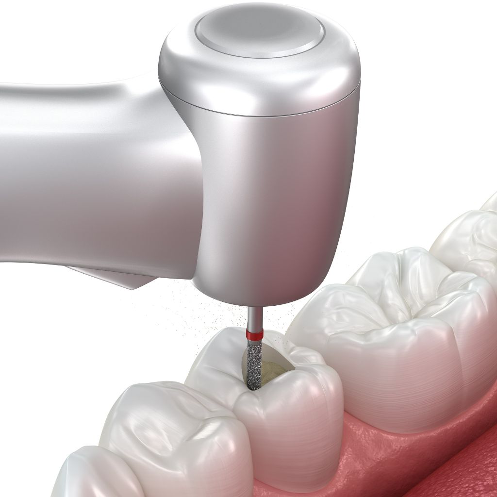 root canal