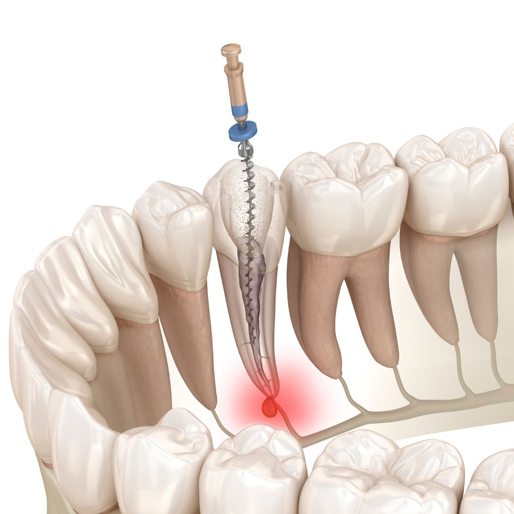 root canal cleaning