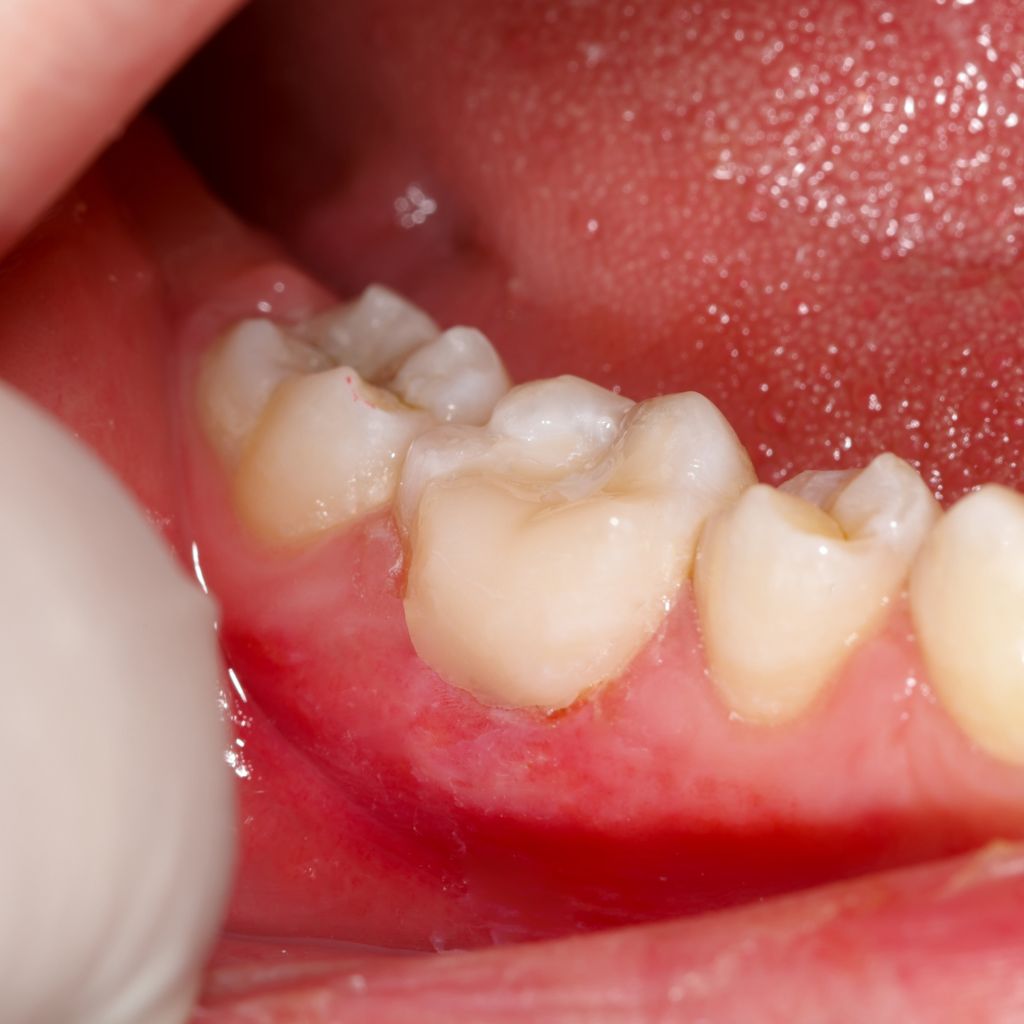 root canal restoration