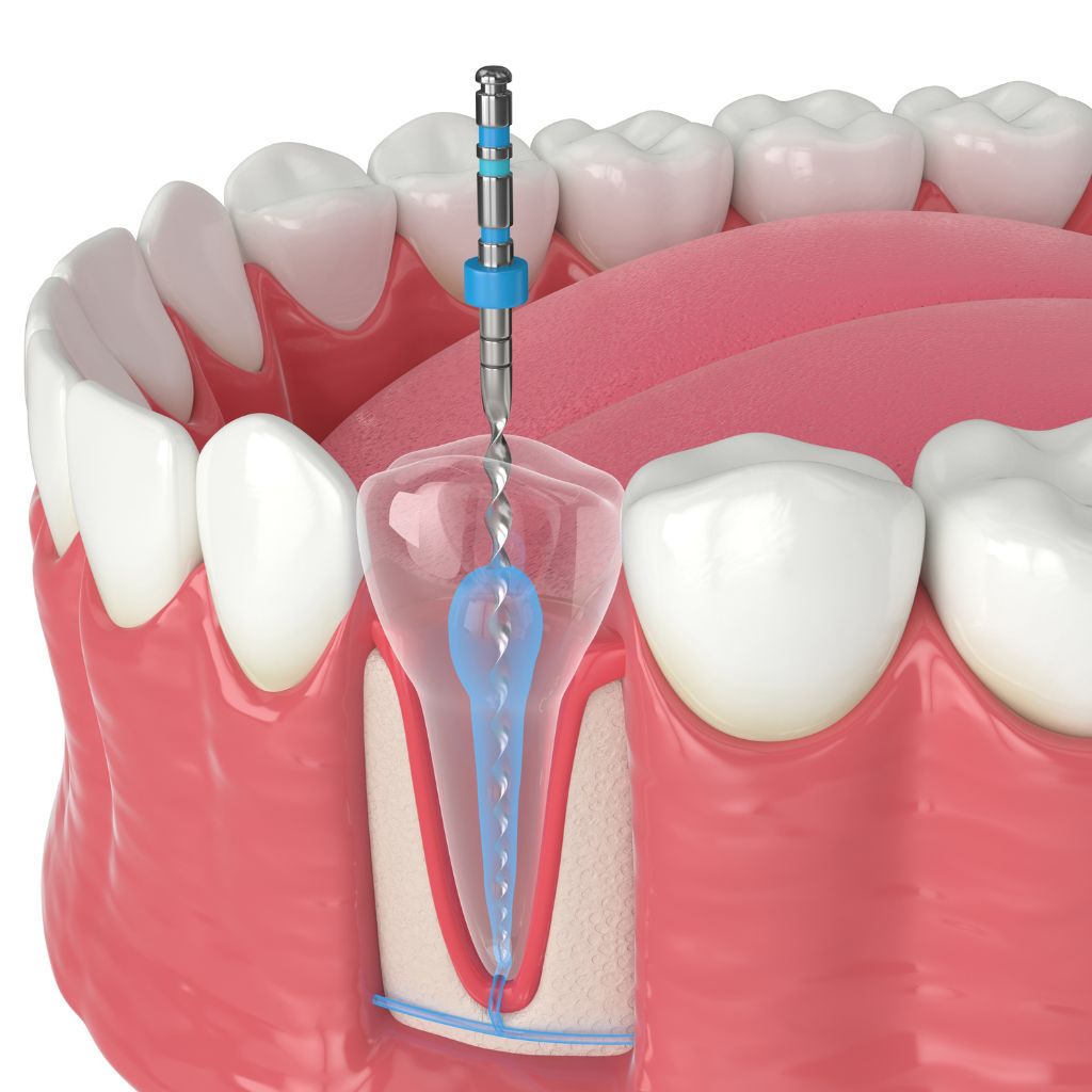 root canal NYC