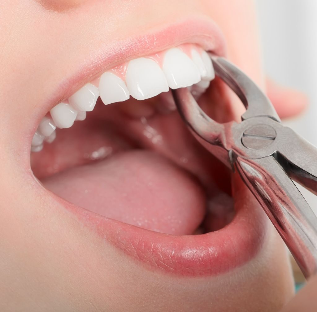 tooth extraction process