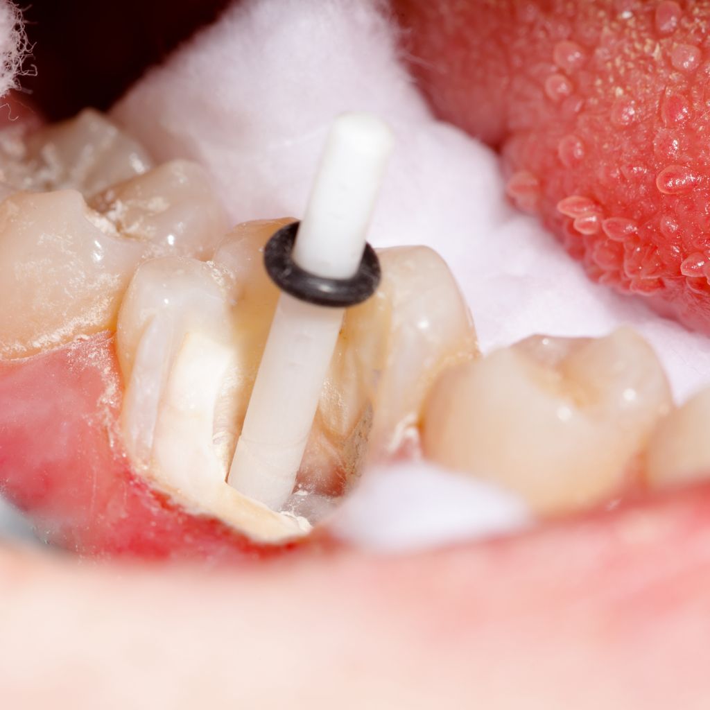 tooth filling