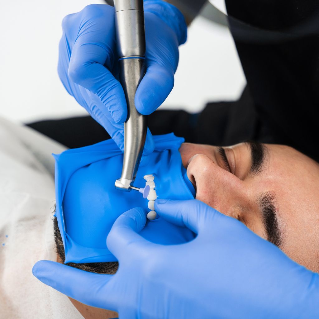 veneers