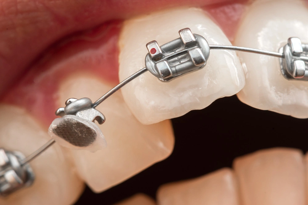 Orthodontic Emergencies Img