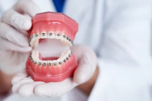 Braces On Teeth Image
