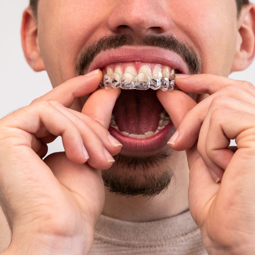 caring for retainers