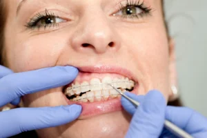 Tightening Braces Image