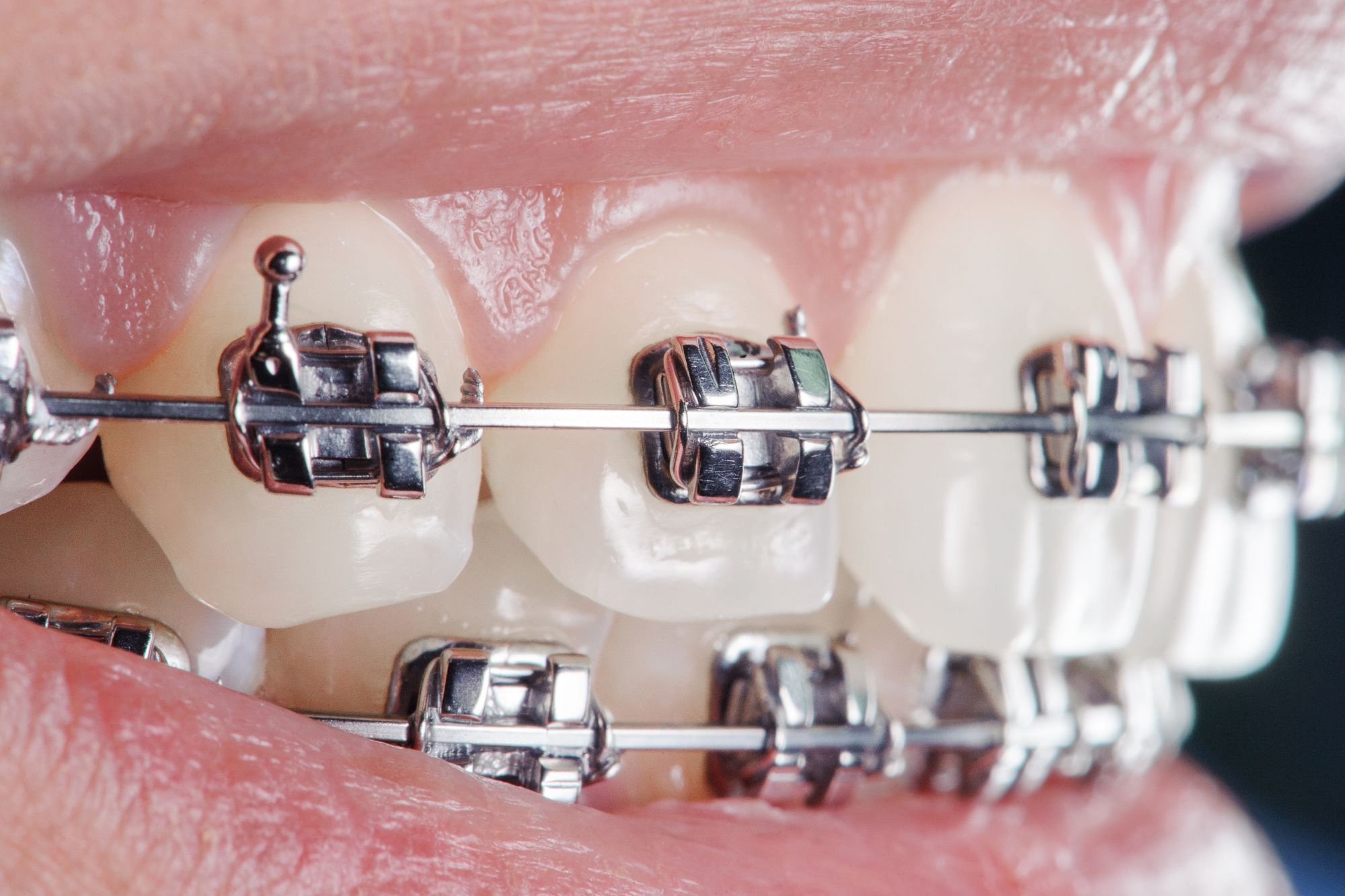 braces with dental crowns