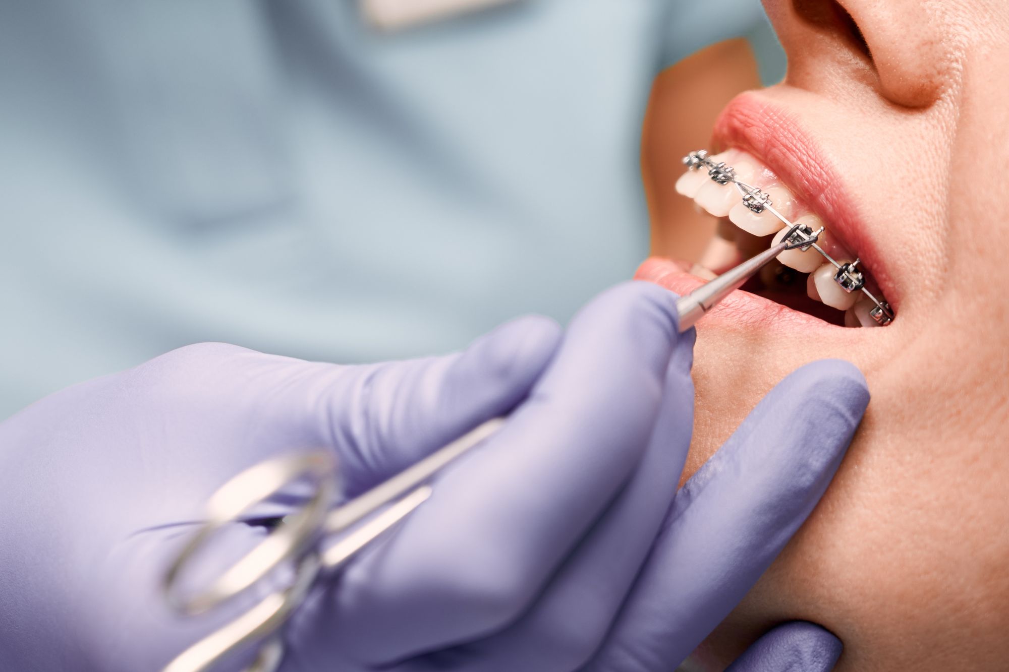 dental spacers