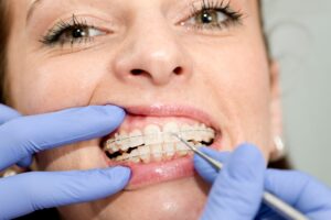 tightening braces