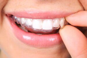 wearing a retainer after braces