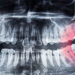 wisdom teeth