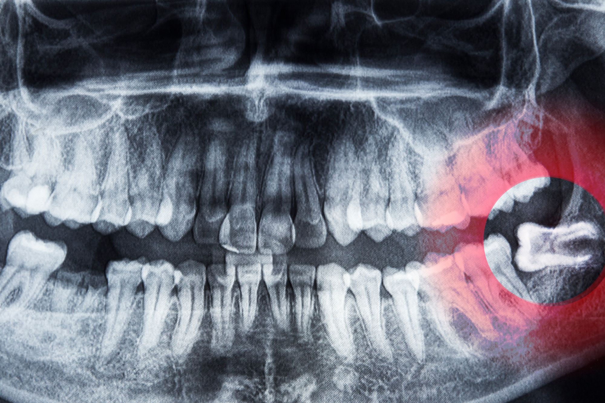 wisdom teeth