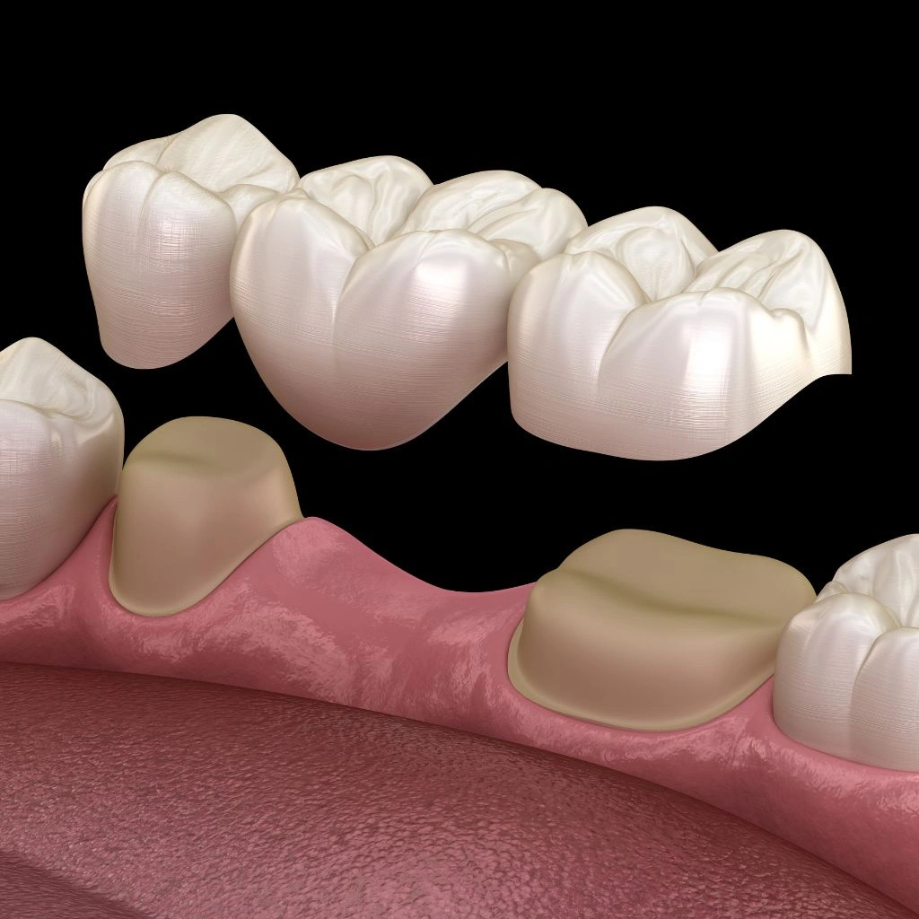 Dental Bridge Image