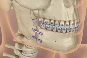 orthognatic surgery