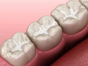Molar Fissure dental Image