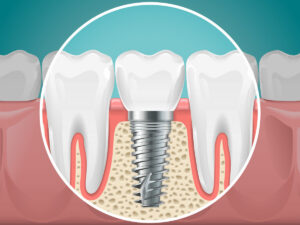 Stomatology illustrations. Dental implants and healthy teeth. Vector health tooth and implant stomatology, dentistry installation and fixture