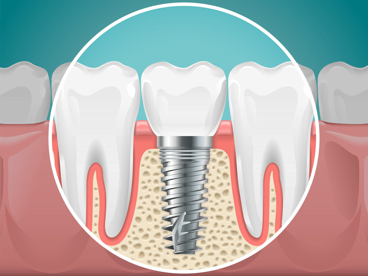 Stomatology illustrations. Dental implants and healthy teeth. Vector health tooth and implant stomatology, dentistry installation and fixture