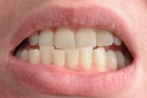 A Young Woman Shows Her Crooked Teeth Image
