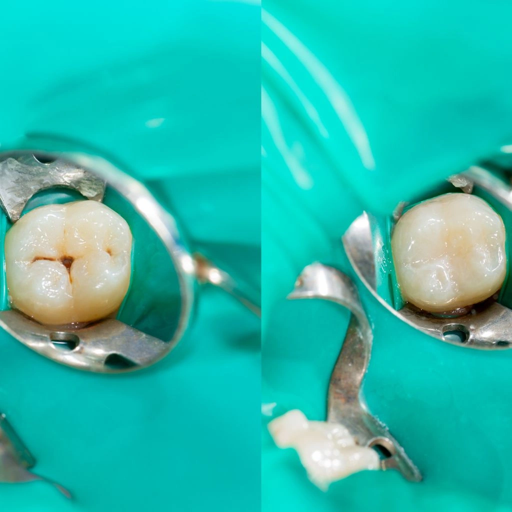 Dental Sealants Img