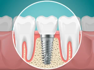 Dental Implants And Healthy Teeth Image