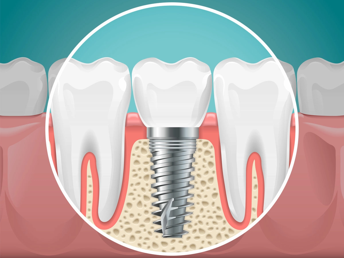 Dental Implants And Healthy Teeth Image