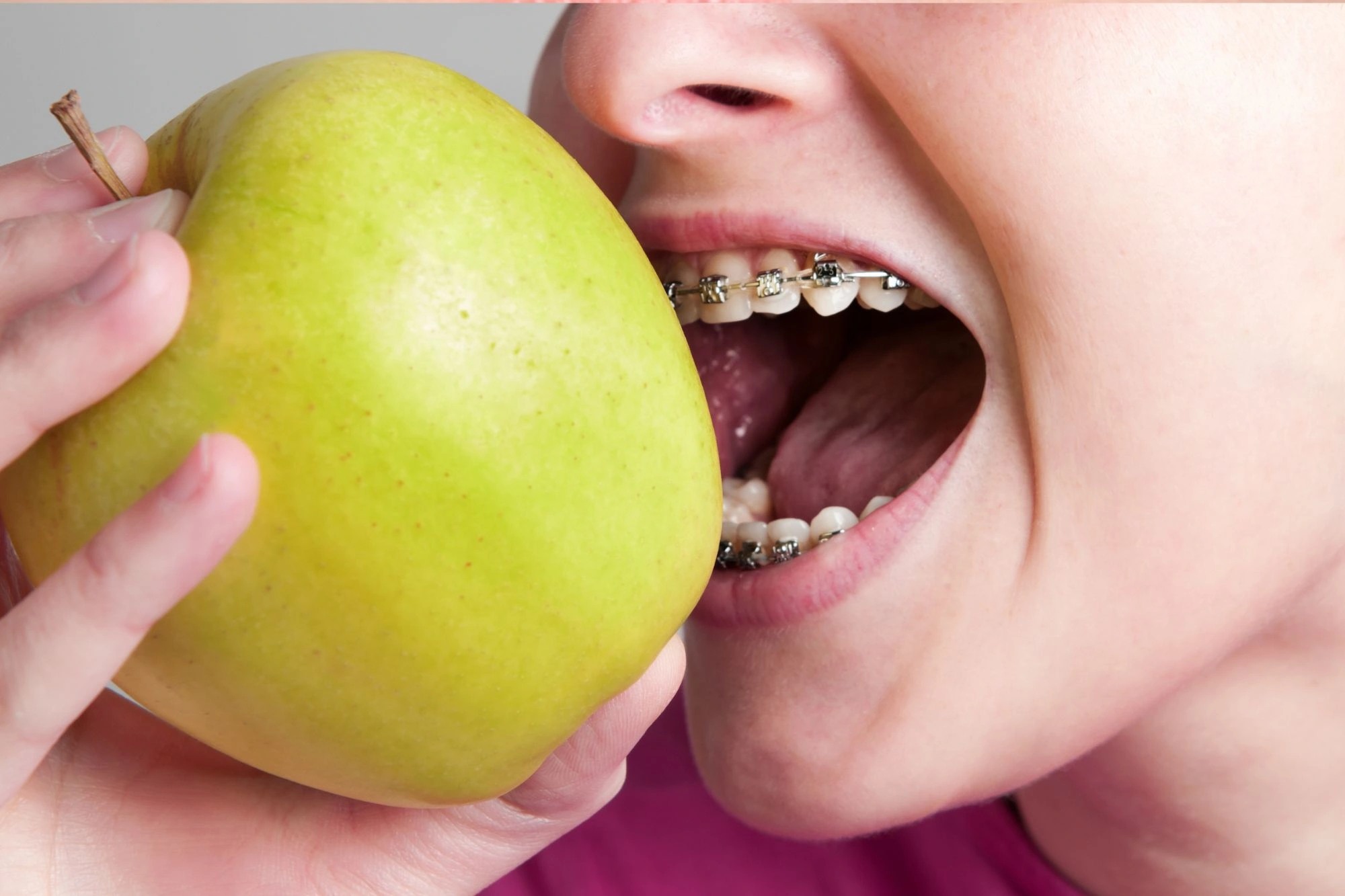Eating With Braces Image
