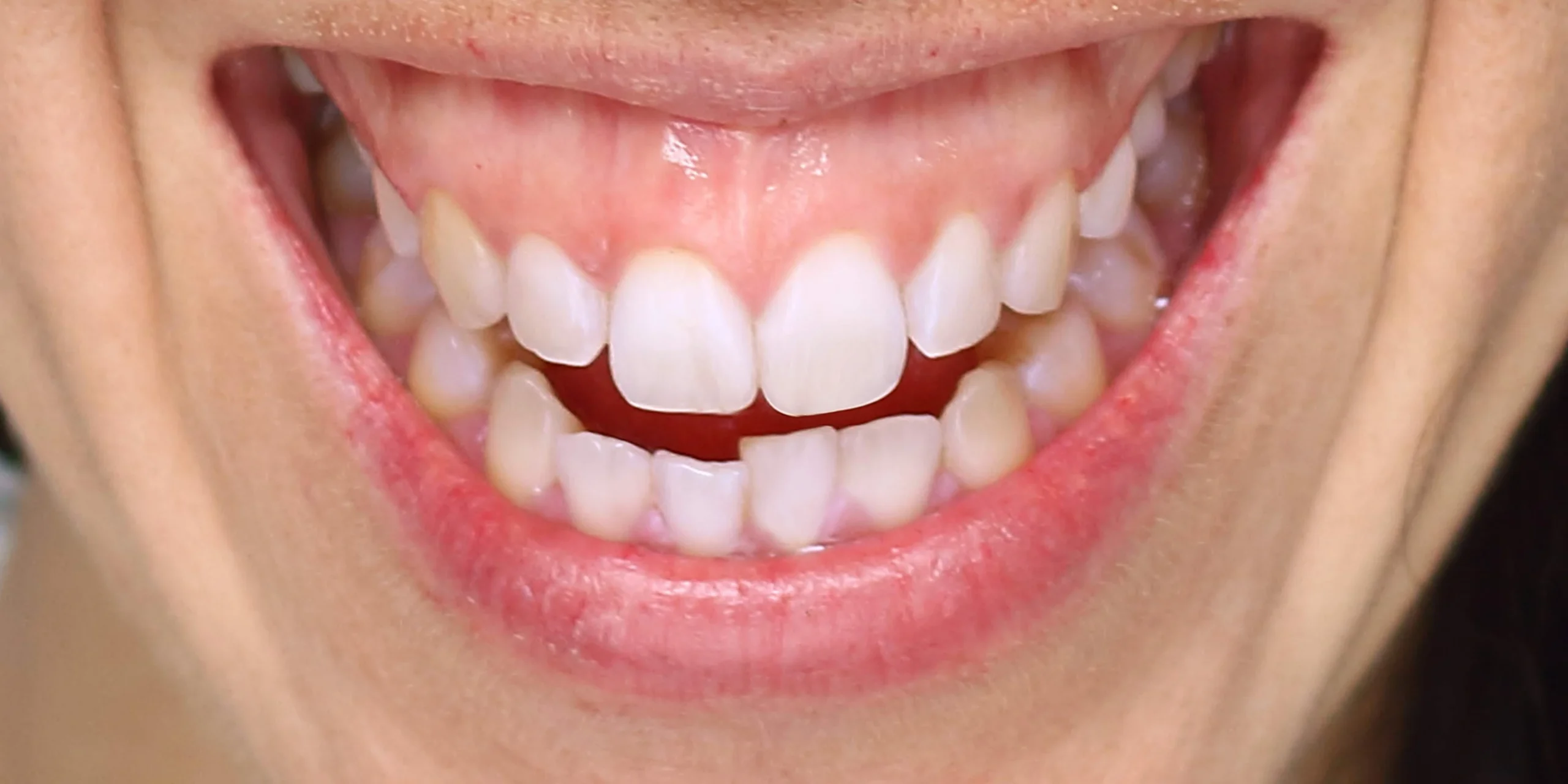 Gummy Smile Correction Image