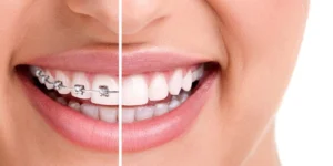 You Need Braces Image