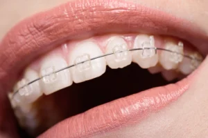 Ceramic Braces Images